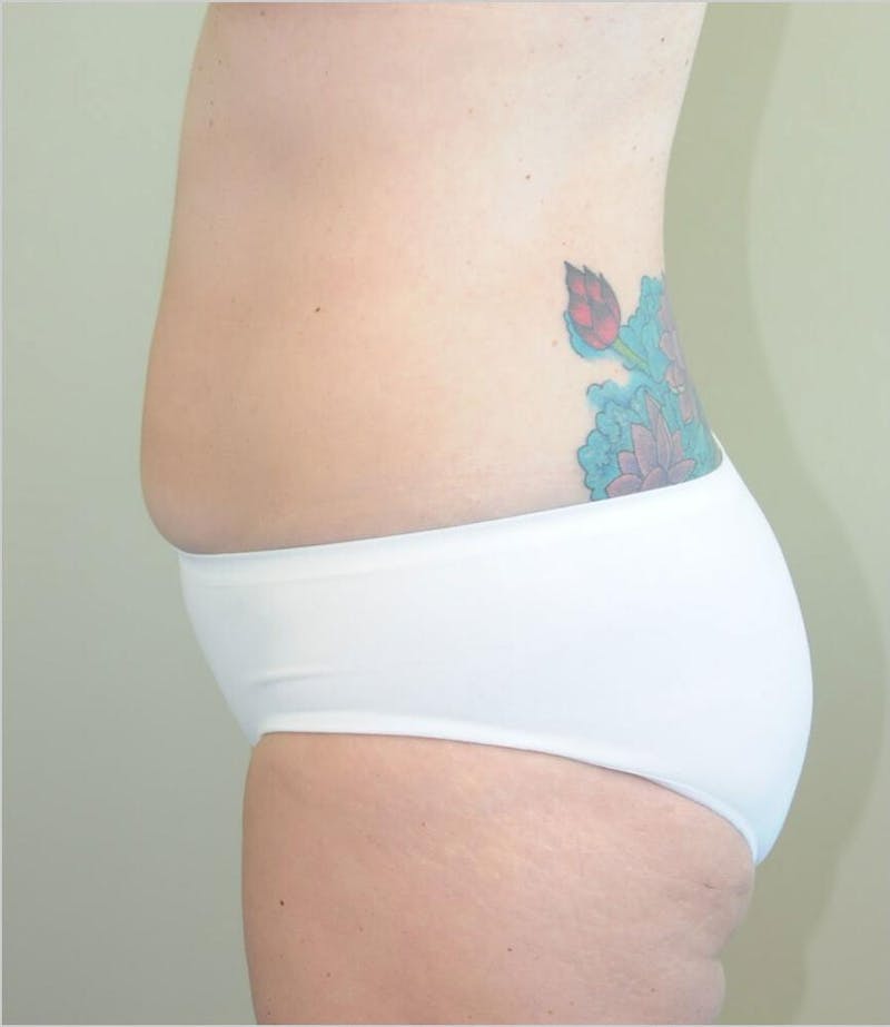 Liposuction Before & After Gallery - Patient 191405040 - Image 3