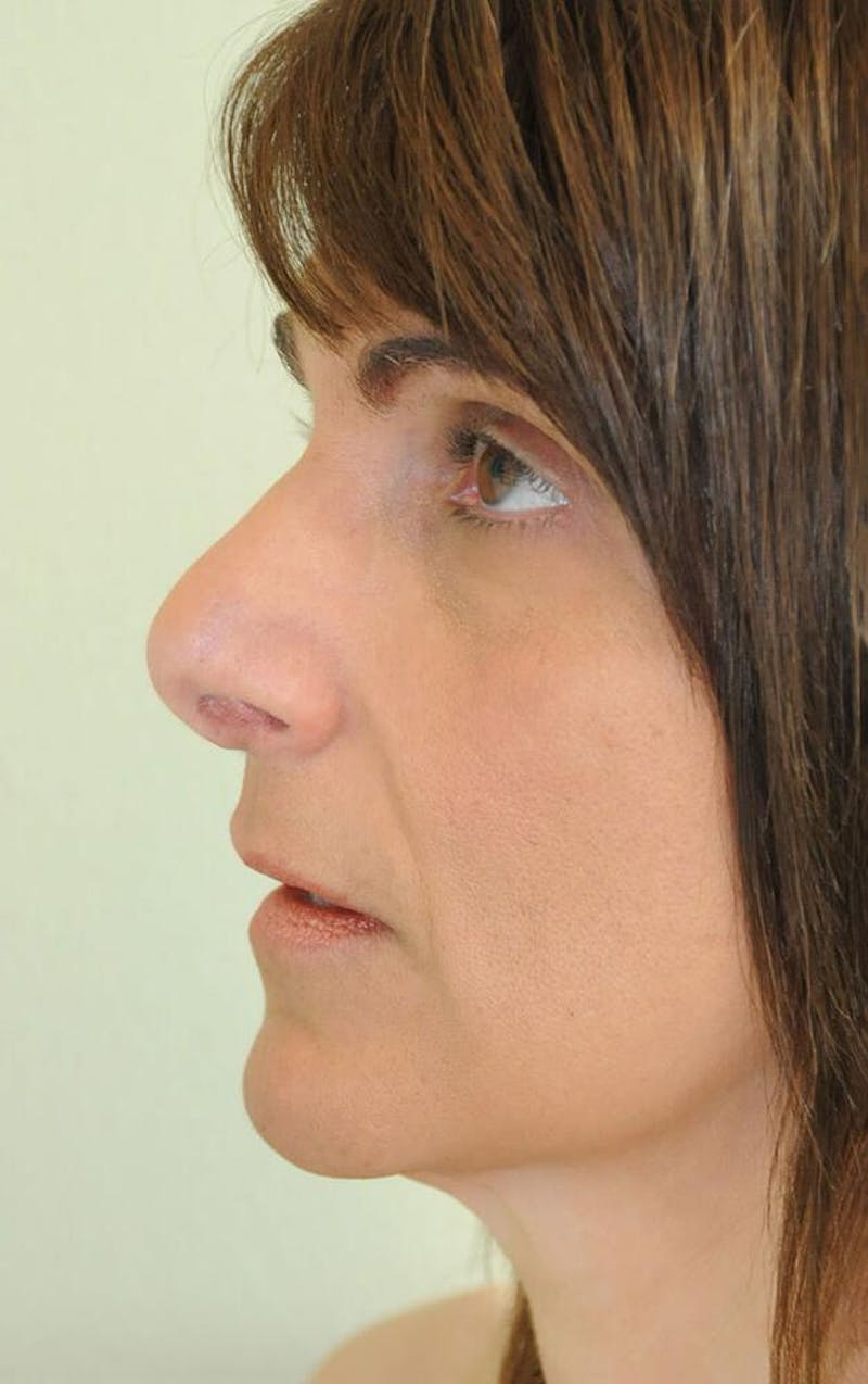 Rhinoplasty Before & After Gallery - Patient 191405039 - Image 4