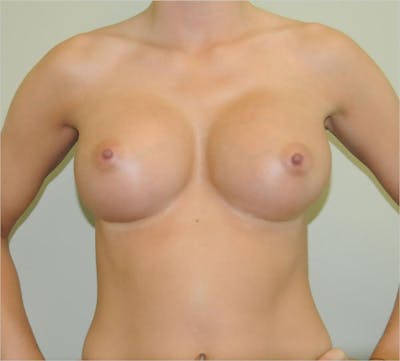 Breast Augmentation Before & After Gallery - Patient 191405041 - Image 2