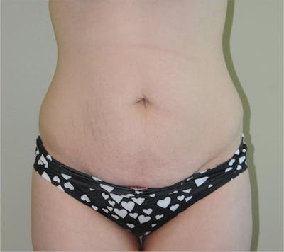 Tummy Tuck Before & After Gallery - Patient 191405045 - Image 1