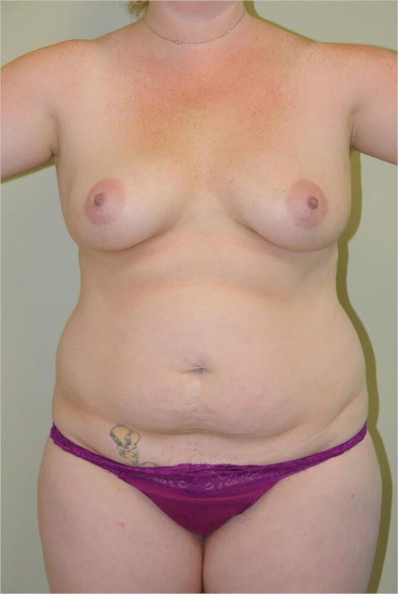 Mommy Makeover Before & After Gallery - Patient 191405044 - Image 1