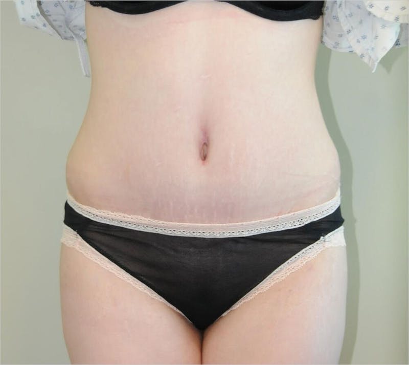 Tummy Tuck Before & After Gallery - Patient 191405045 - Image 2