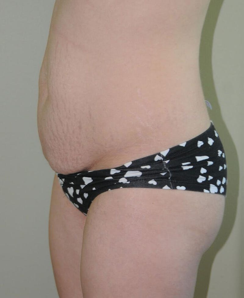 Tummy Tuck Before & After Gallery - Patient 191405045 - Image 3