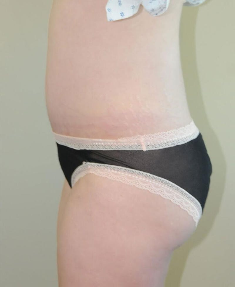 Tummy Tuck Before & After Gallery - Patient 191405045 - Image 4