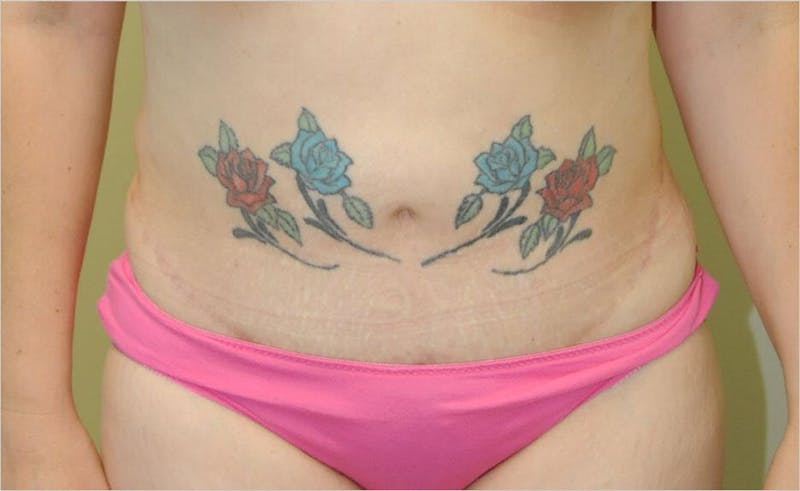 Liposuction Before & After Gallery - Patient 191405048 - Image 1