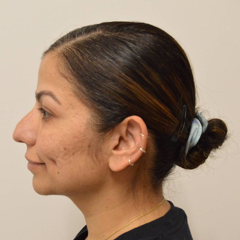 Neck Liposuction Before & After Gallery - Patient 191405043 - Image 6