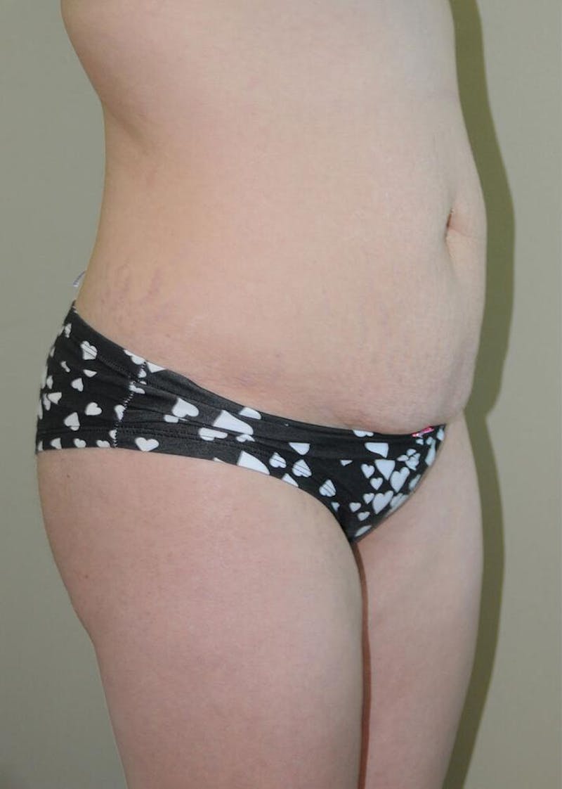 Tummy Tuck Before & After Gallery - Patient 191405045 - Image 5
