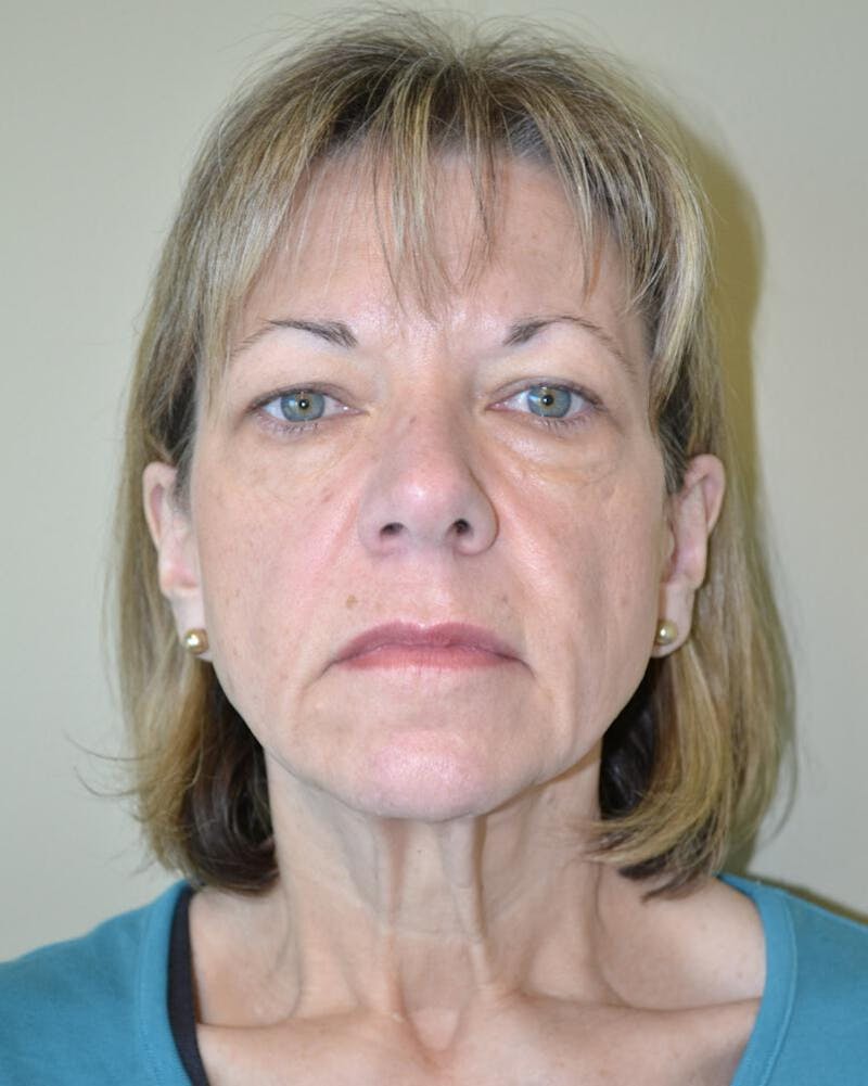 Face and Neck Lifts Before & After Gallery - Patient 191405047 - Image 1