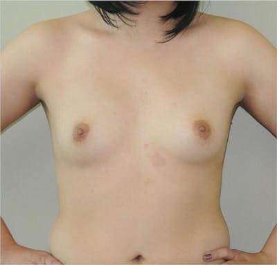 Breast Augmentation Before & After Gallery - Patient 191405049 - Image 1