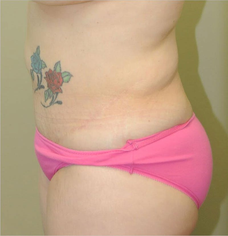 Liposuction Before & After Gallery - Patient 191405048 - Image 3