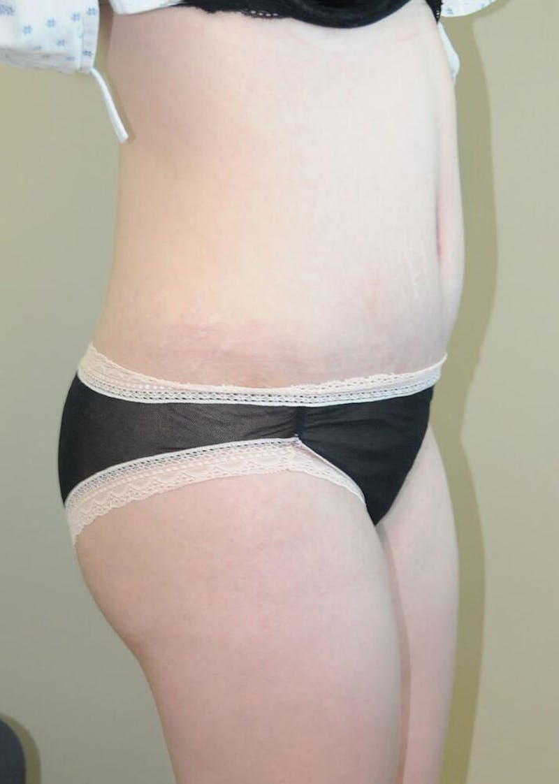 Tummy Tuck Before & After Gallery - Patient 191405045 - Image 6