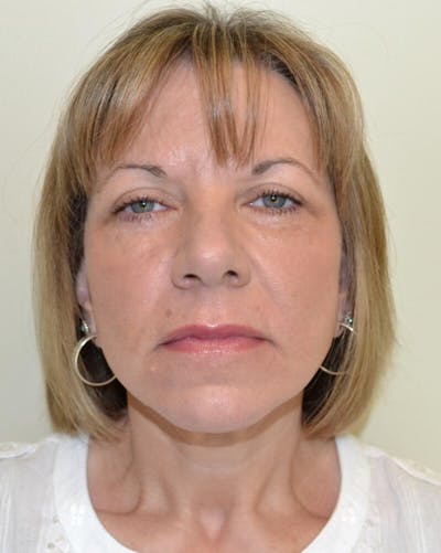 Face and Neck Lifts Before & After Gallery - Patient 191405047 - Image 2