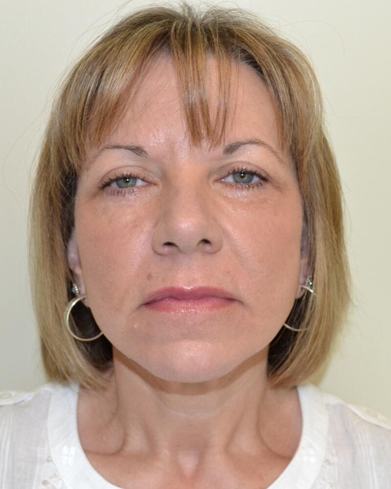 Face and Neck Lifts Before & After Gallery - Patient 191405047 - Image 2