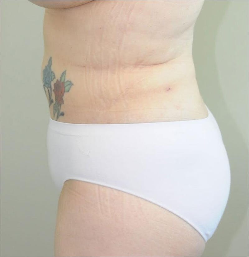 Liposuction Before & After Gallery - Patient 191405048 - Image 4