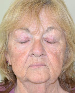 Lip Augmentation Before & After Gallery - Patient 191405046 - Image 6