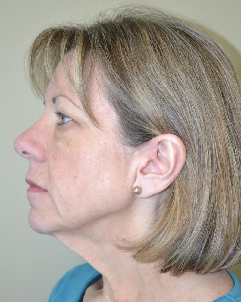 Face and Neck Lifts Before & After Gallery - Patient 191405047 - Image 3