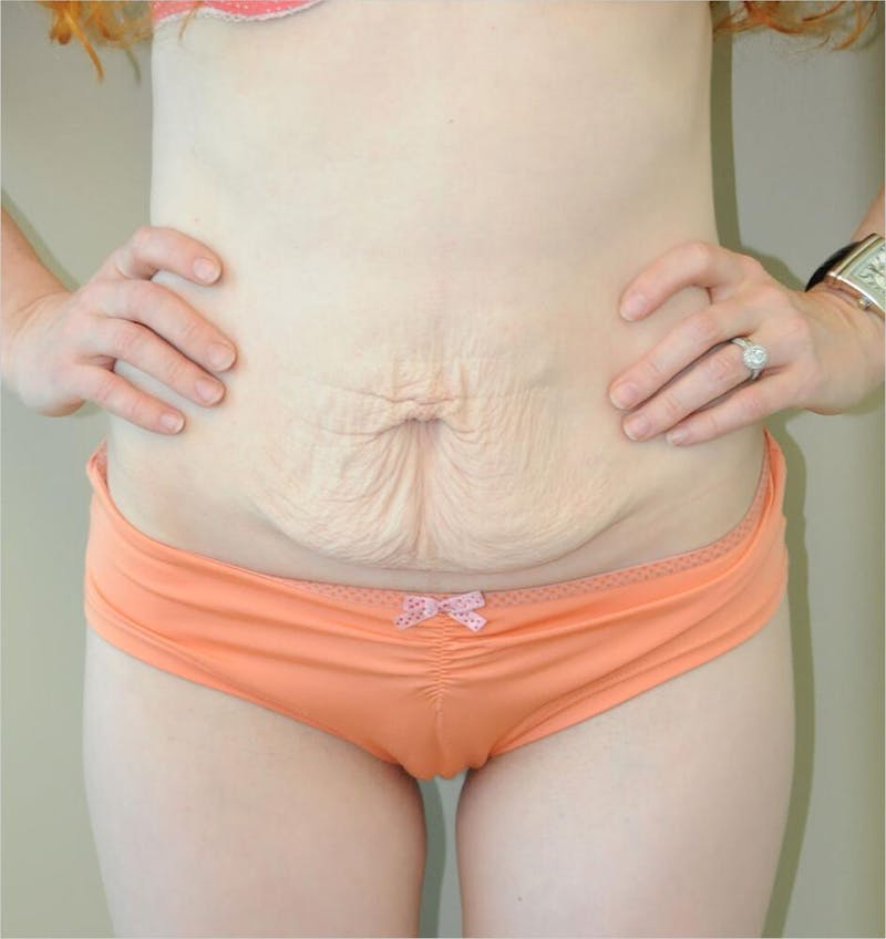 Tummy Tuck Before & After Gallery - Patient 191445056 - Image 1