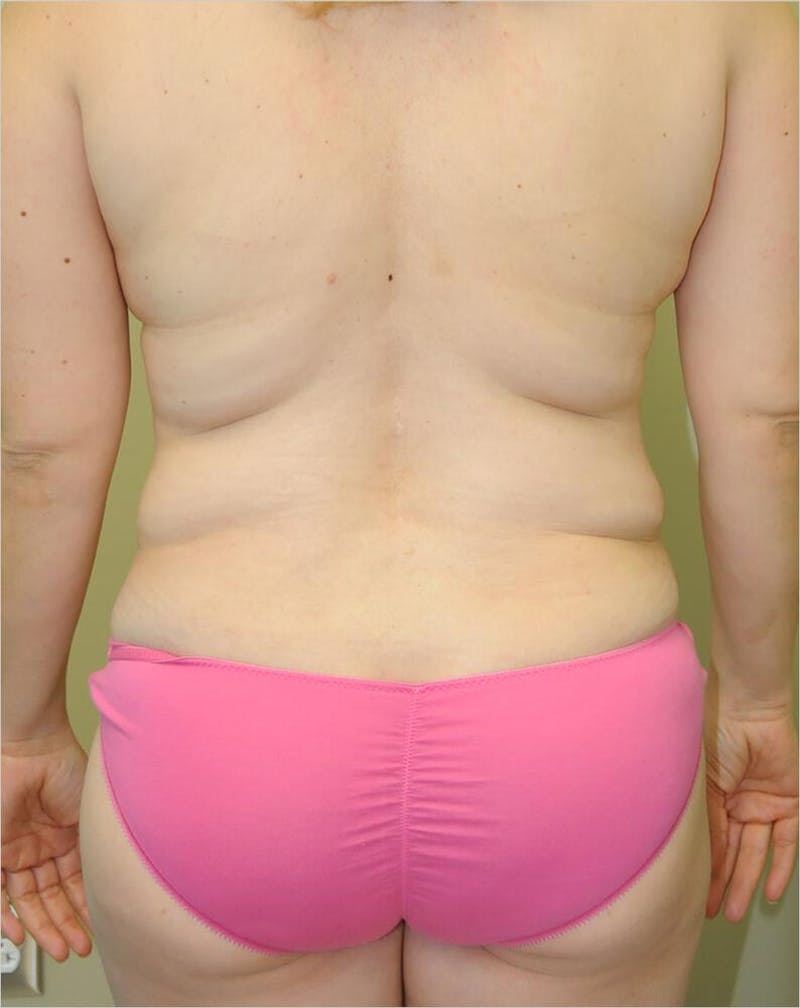 Liposuction Before & After Gallery - Patient 191405048 - Image 5