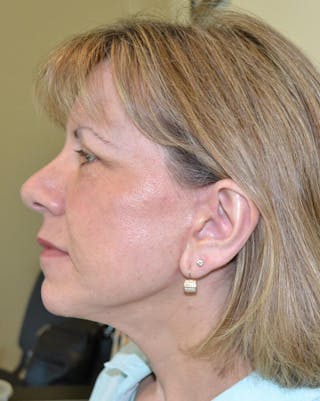 Face and Neck Lifts Before & After Gallery - Patient 669853 - Image 4