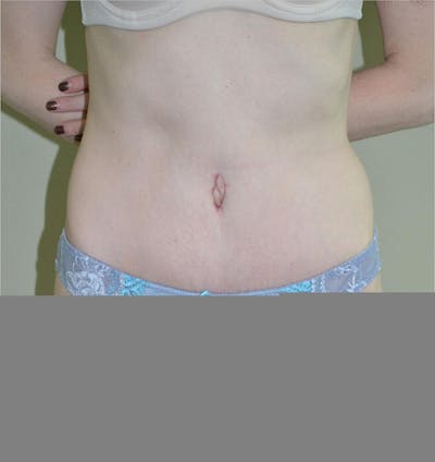 Tummy Tuck Before & After Gallery - Patient 191445056 - Image 2