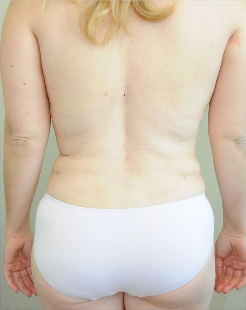 Liposuction Before & After Gallery - Patient 191405048 - Image 6