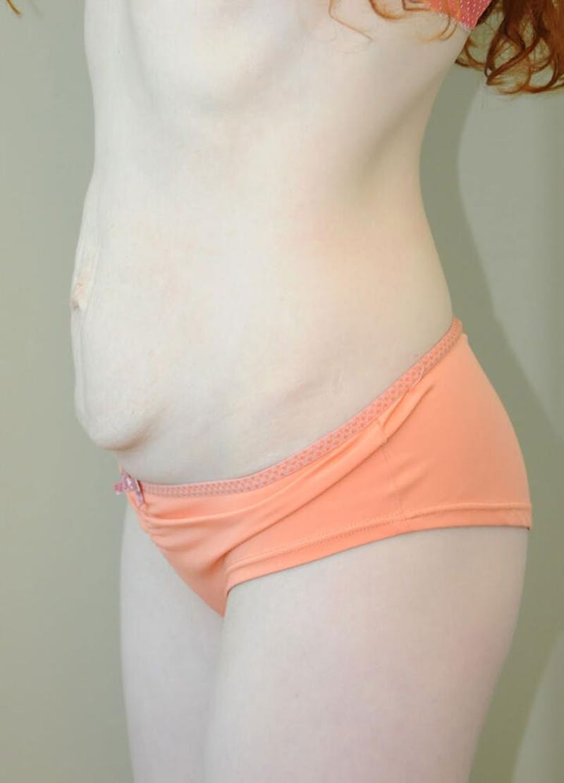 Tummy Tuck Before & After Gallery - Patient 191445056 - Image 3