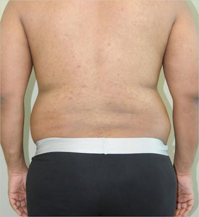 Liposuction Before & After Gallery - Patient 191492568 - Image 1