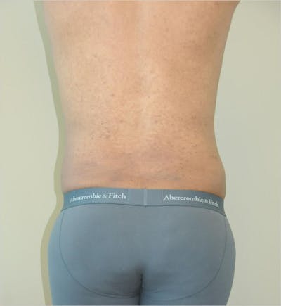 Liposuction Before & After Gallery - Patient 191492568 - Image 2
