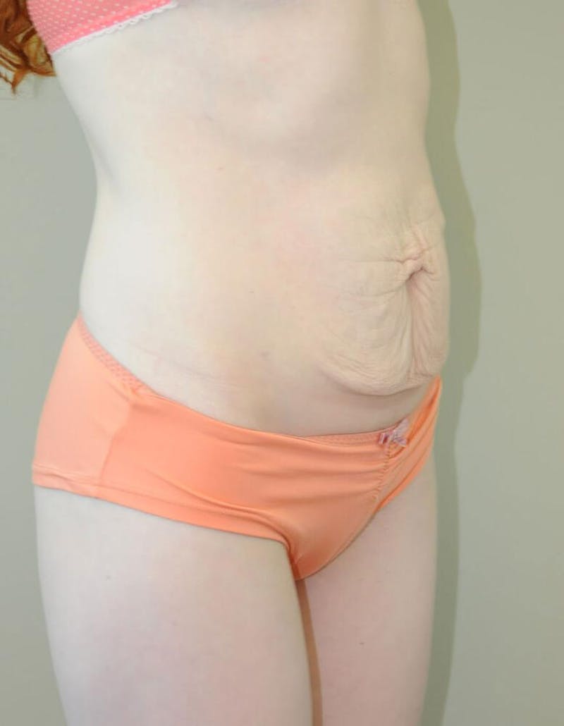 Tummy Tuck Before & After Gallery - Patient 191445056 - Image 5