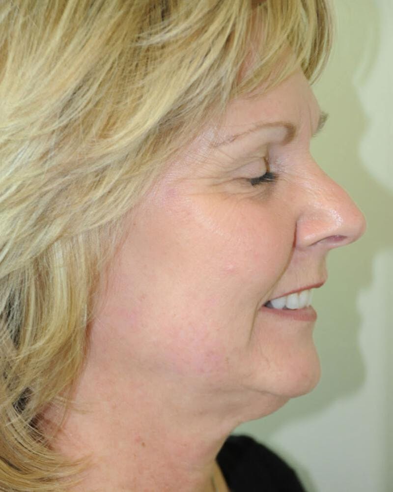 Face and Neck Lifts Before & After Gallery - Patient 191445057 - Image 3