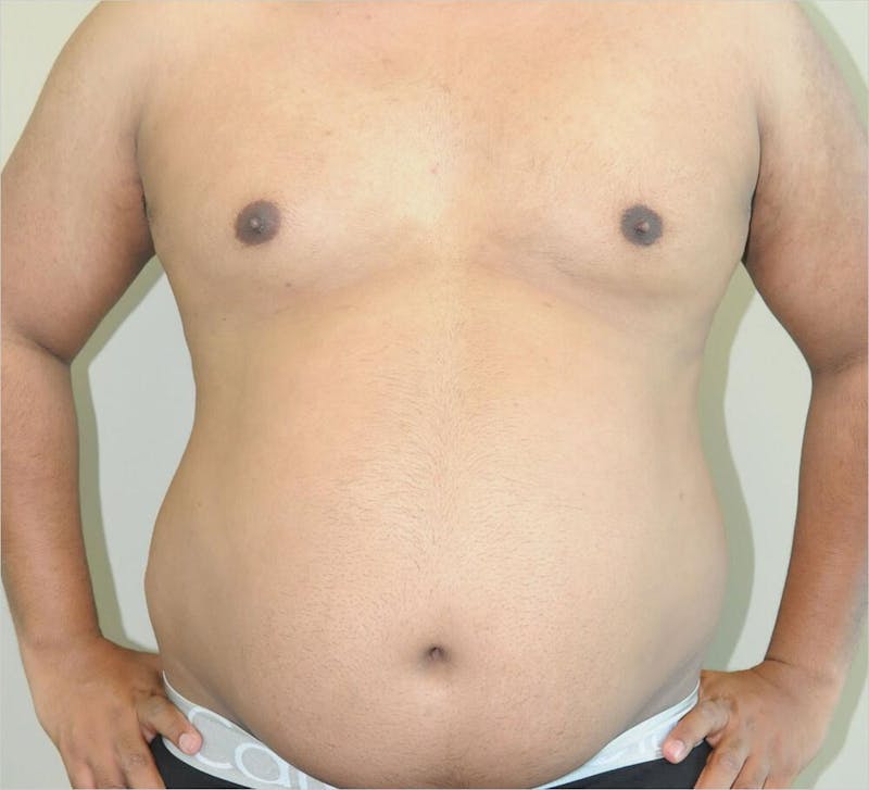Liposuction Before & After Gallery - Patient 191492568 - Image 3