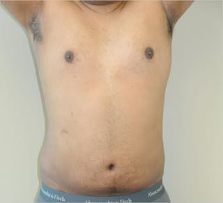 Liposuction Before & After Gallery - Patient 191492568 - Image 4