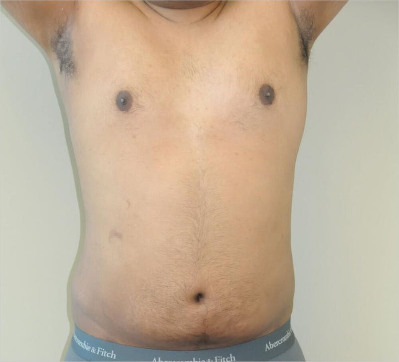 Liposuction Before & After Gallery - Patient 191492568 - Image 4