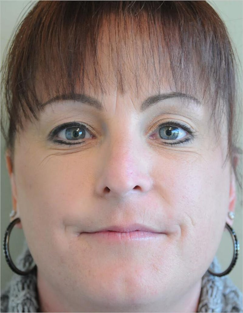 Lip Augmentation Before & After Gallery - Patient 191558229 - Image 1