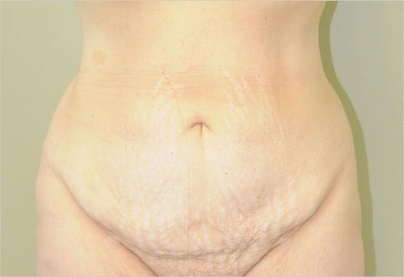 Tummy Tuck Before & After Gallery - Patient 191563238 - Image 1