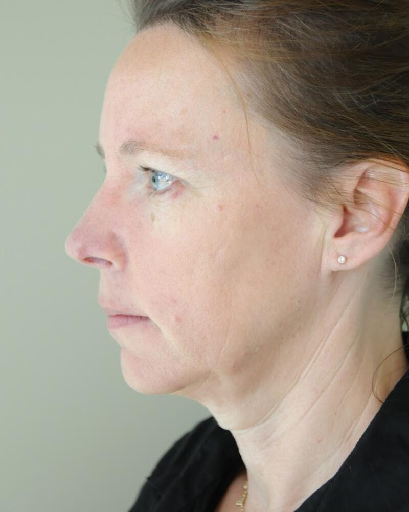Face and Neck Lifts Before & After Gallery - Patient 191495059 - Image 1