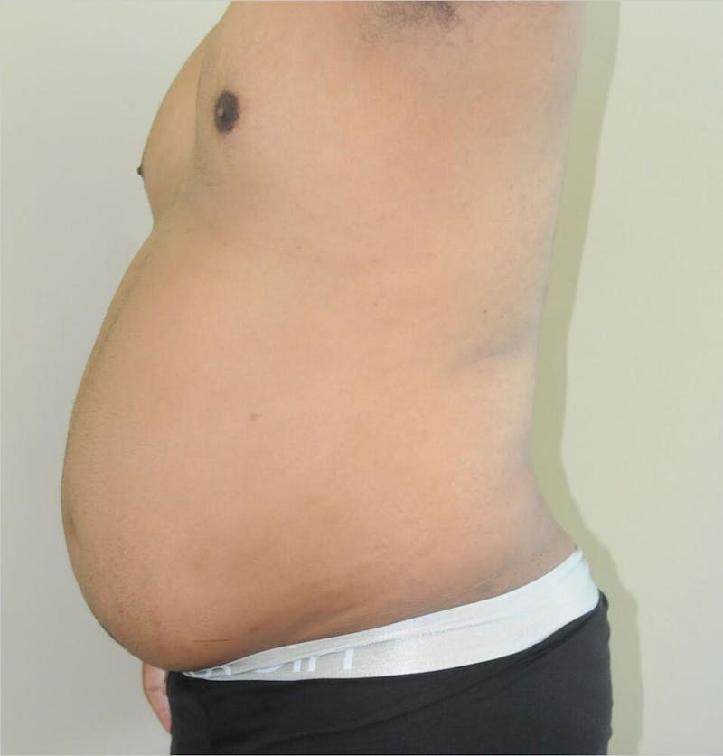 Liposuction Before & After Gallery - Patient 191492568 - Image 5