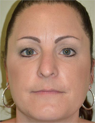 Lip Augmentation Before & After Gallery - Patient 191558229 - Image 2
