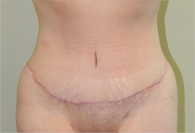 Tummy Tuck Before & After Gallery - Patient 191563238 - Image 2