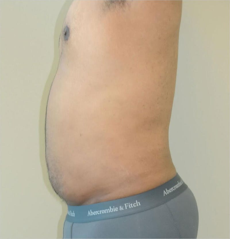 Liposuction Before & After Gallery - Patient 191492568 - Image 6