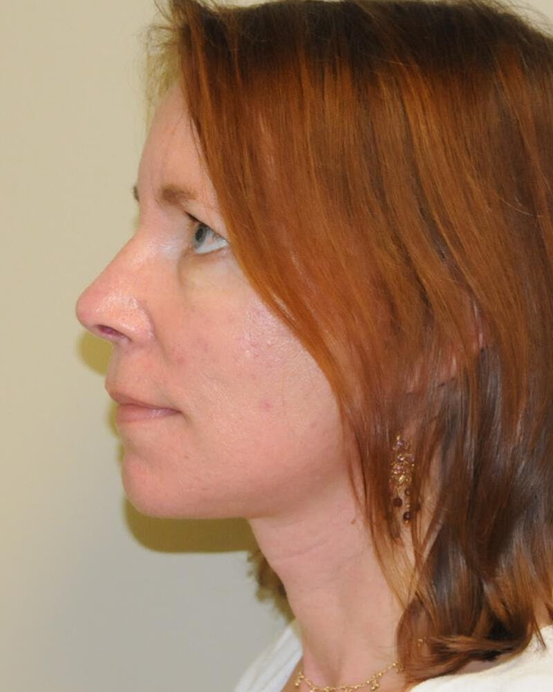 Face and Neck Lifts Before & After Gallery - Patient 191495059 - Image 2