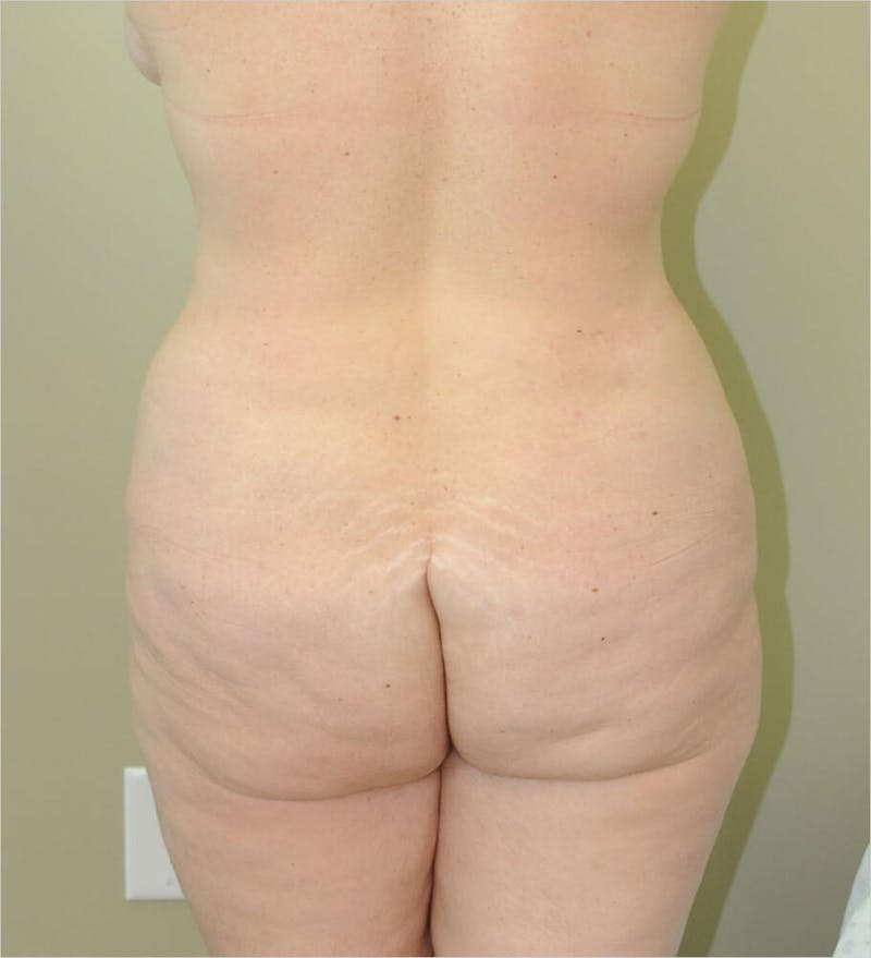 Tummy Tuck Before & After Gallery - Patient 191563238 - Image 3