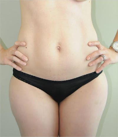 Liposuction Before & After Gallery - Patient 191614393 - Image 1