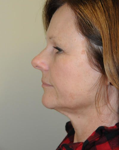 Face and Neck Lifts Before & After Gallery - Patient 191544183 - Image 1