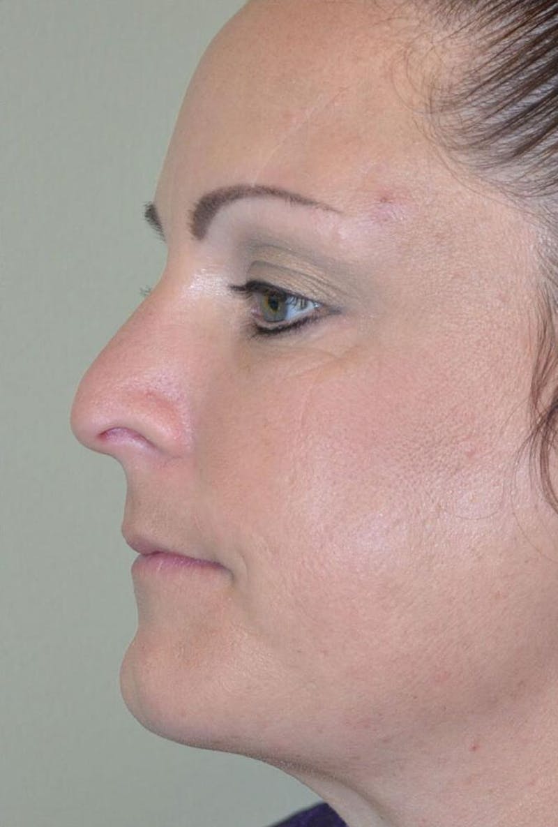 Lip Augmentation Before & After Gallery - Patient 191558229 - Image 4