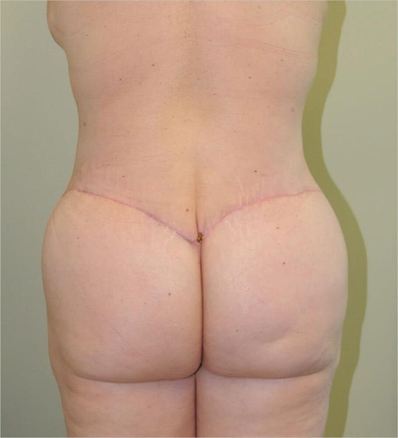 Tummy Tuck Before & After Gallery - Patient 191563238 - Image 4
