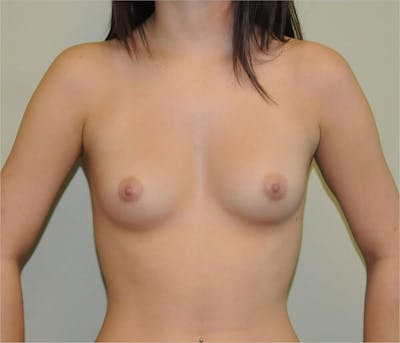 Breast Augmentation Before & After Gallery - Patient 191639433 - Image 1