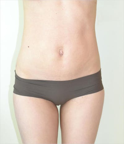 Liposuction Before & After Gallery - Patient 191614393 - Image 2