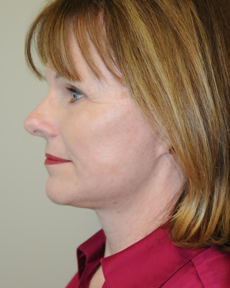 Face and Neck Lifts Before & After Gallery - Patient 191544183 - Image 2