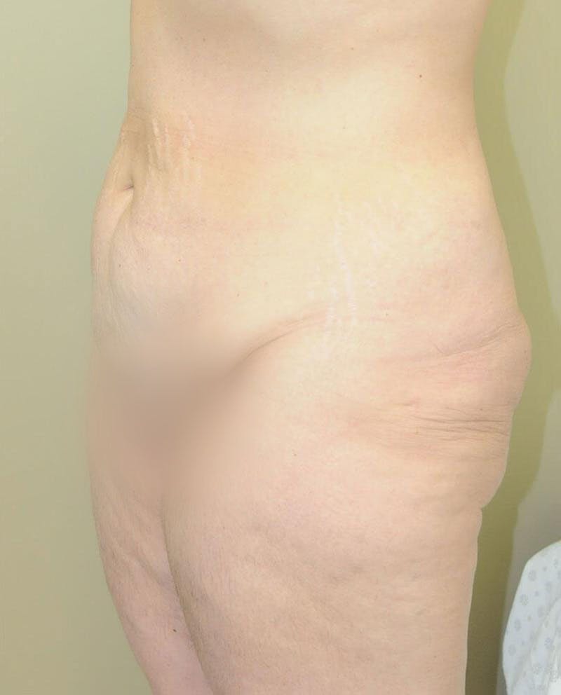 Tummy Tuck Before & After Gallery - Patient 191563238 - Image 5